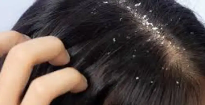 dandruff ko htane ke tarike