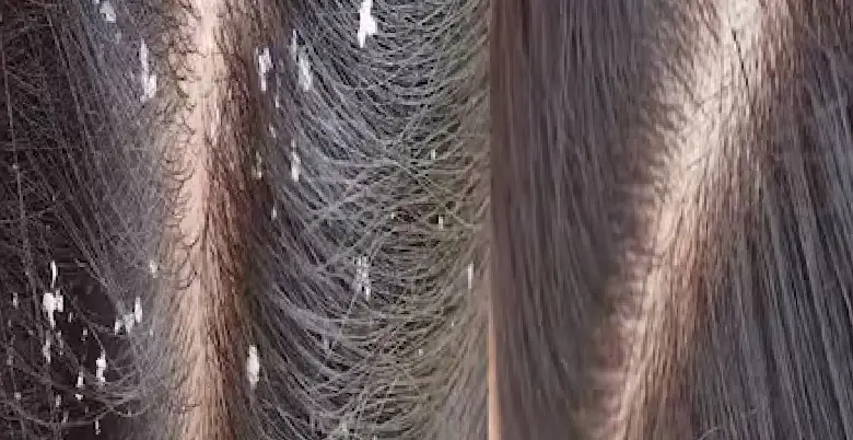 dandruff ke liye kya lgana chahiye