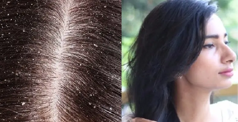 dandruff ke liye ghrelu nuskhe