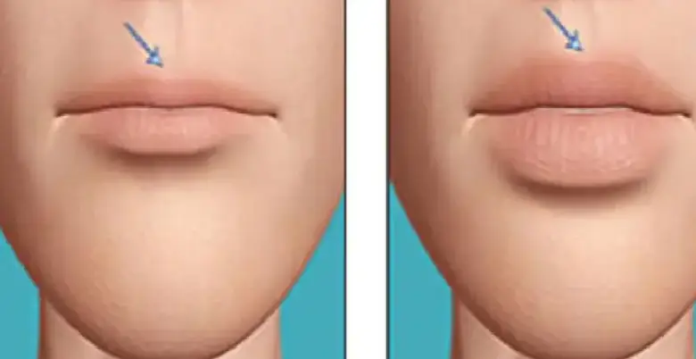 lips surgery coast in India 