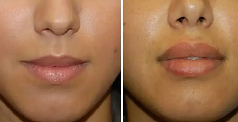 lips surgery benefits 