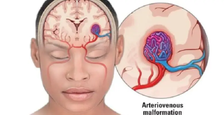 Treatment of AVM