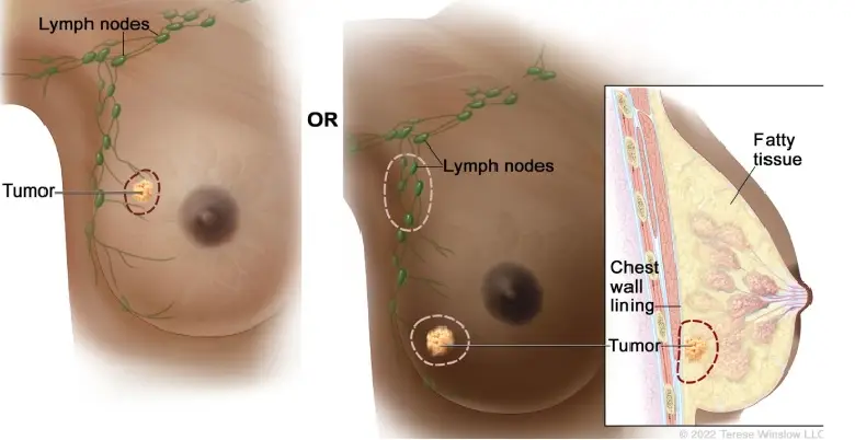 Introduction Breast Cancer Treatment