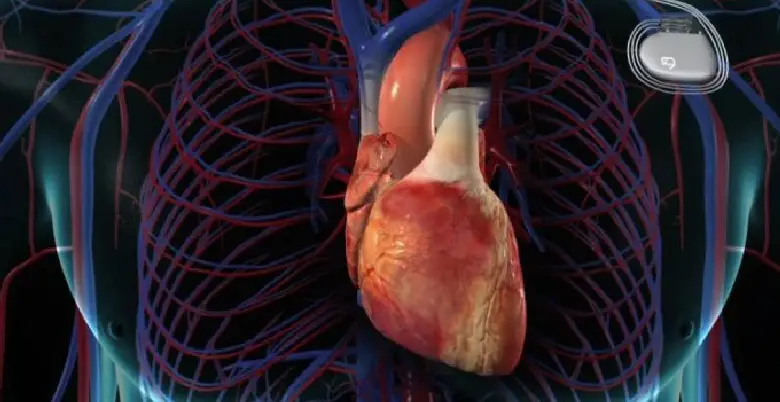 Introduction Cardiac Ablation Treatment