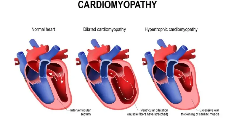 Types of Cardiomyopathy