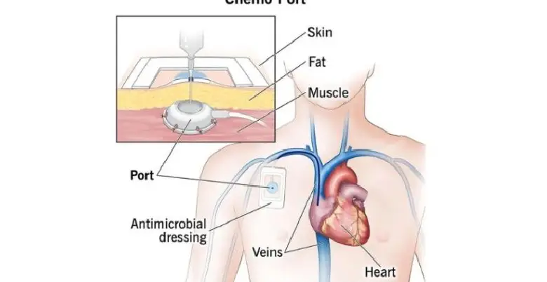 _chemotherapy port