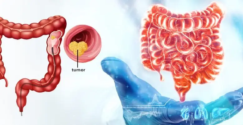 Introduction Colorectal Cancer