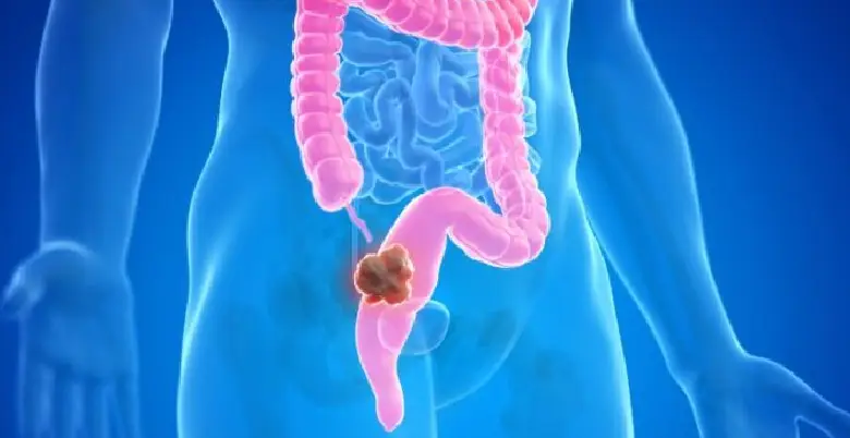 Colorectal cancer risk factors