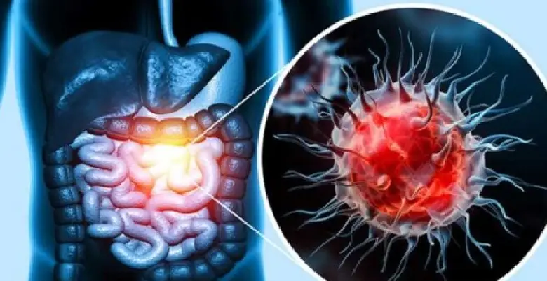 Colorectal cancer types