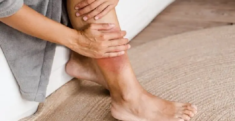 Home remedies of deep vein thrombosis