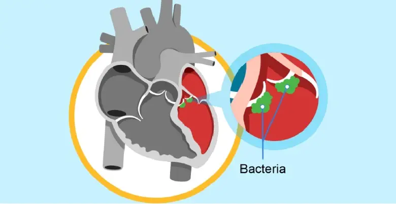 Introduction Endocarditis Treatment