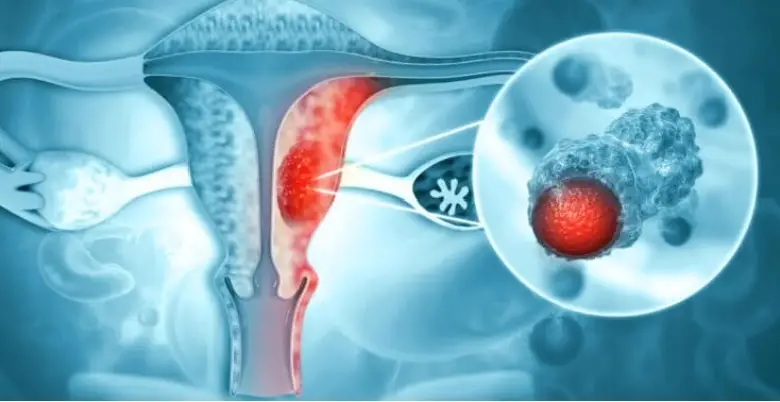 Introduction Endometrial Cancer Treatment