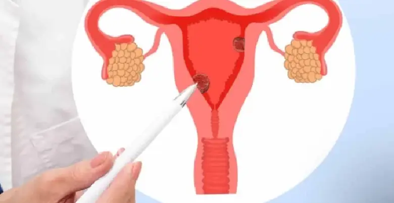 Prognosis of endometrial cancer