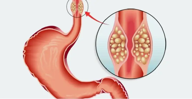 Introduction Esophagus Cancer Treatment