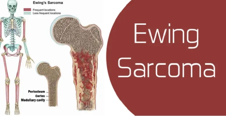 Introduction Ewing Sarcoma Treatment