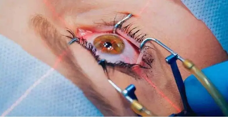 About Eye Transplant