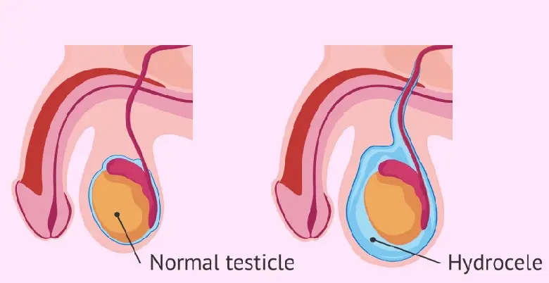 Hydrocele Medical Test kyu jaruri hota hai 