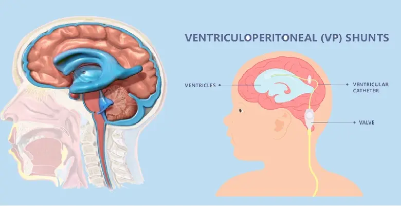 Introduction Hydrocephalus Treatments