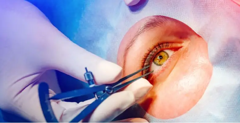 Lasik Surgery Introduction