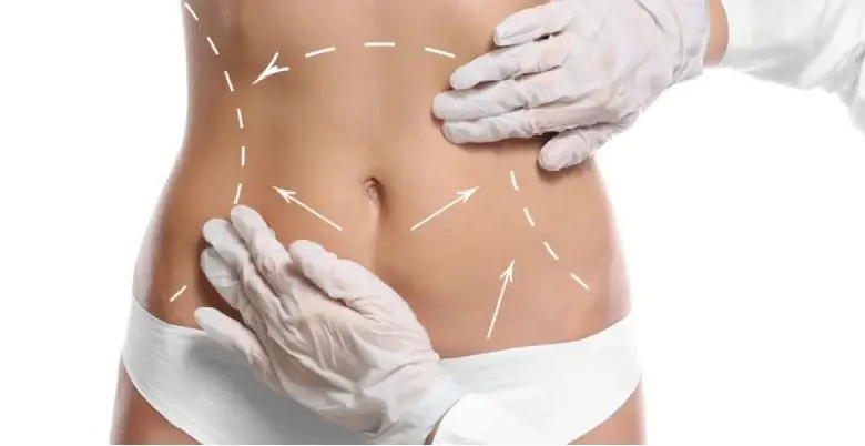 Liposuction Surgery Introduction