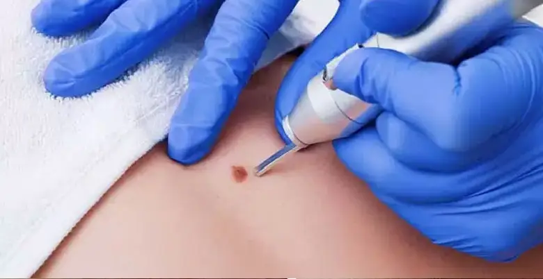 Mole Removal Treatment