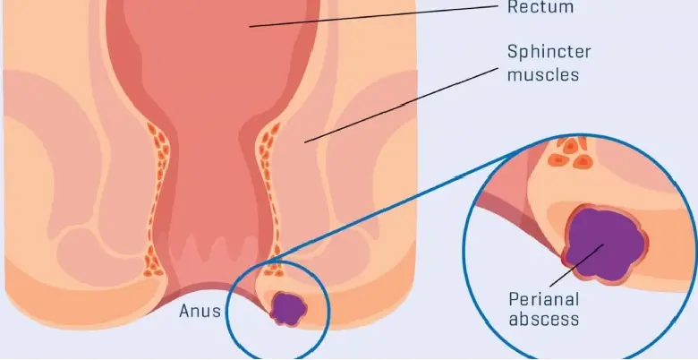 Introduction Perianal Abscess Treatment