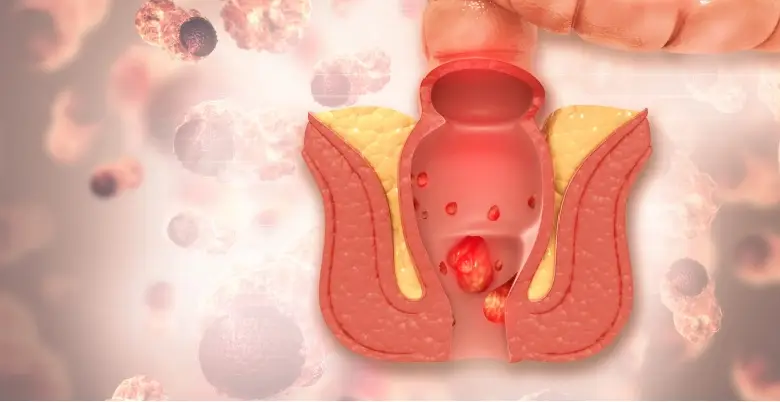 Treatment of Perianal Abscess