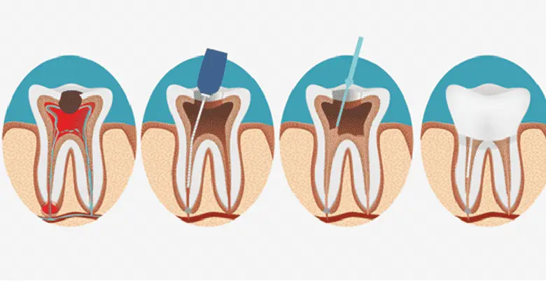 Root Canal Introduction