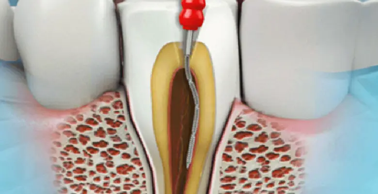 Medical Test for Root Canal Treatment: 