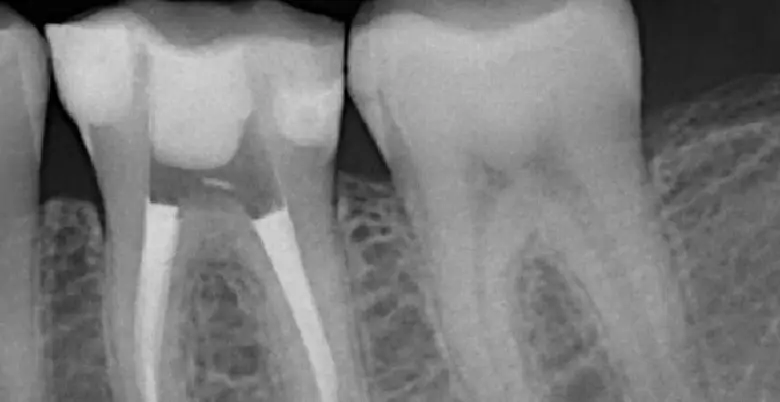 Root Canal Treatment