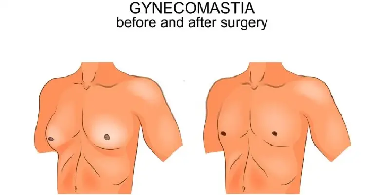 gynecomastia surgery kya hai 