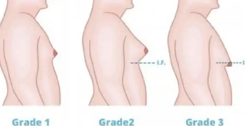 gynecomastia surgery kyu hoti hai 