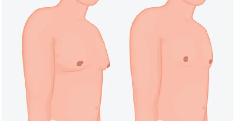 gynecomastia surgery ke fayede