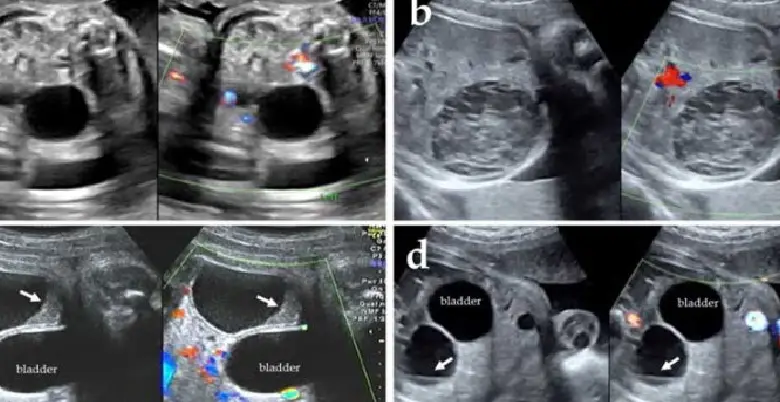 ovarian cyst hone ke karan 