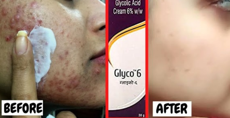 Overview Glyco 6 Cream