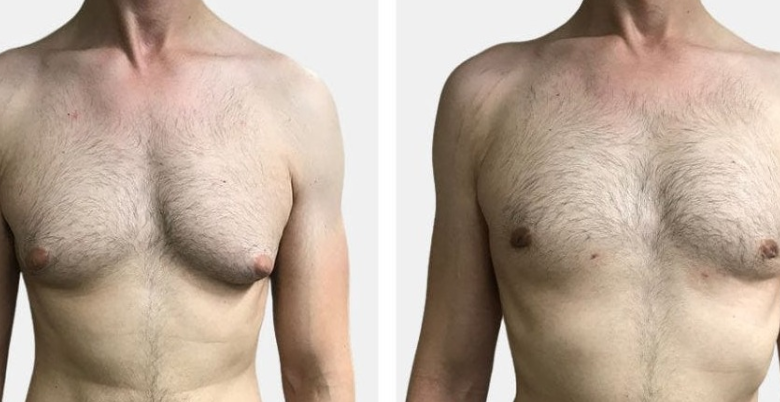 delhi me Gynecomastia Surgery ka karch kitna hai