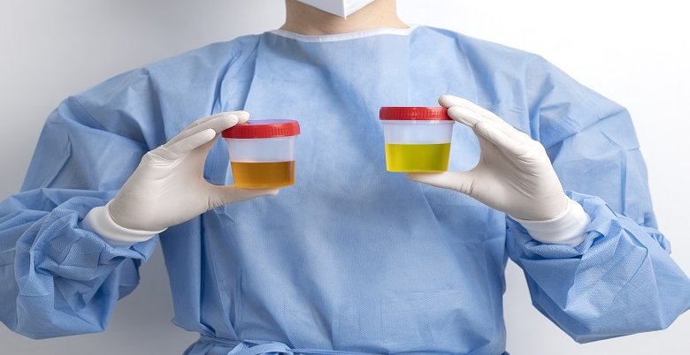 Tips for preparing for a urine culture test.