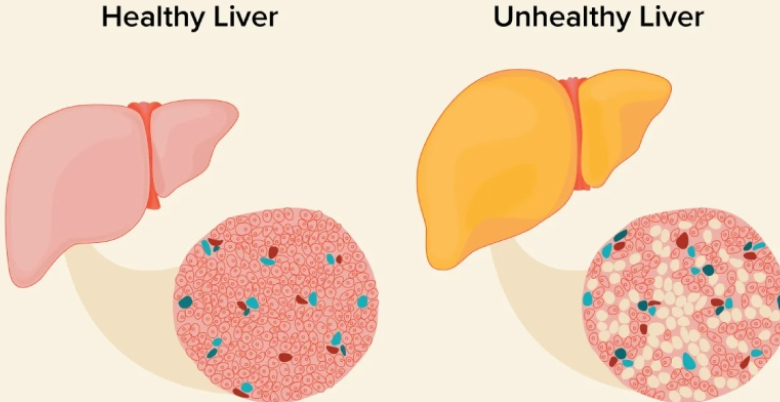 Fatty Liver ke upaay