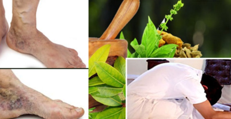 treatment and yoga for Varicose Veins
