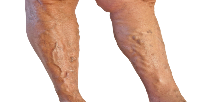 benefits for Varicose Veins problems 