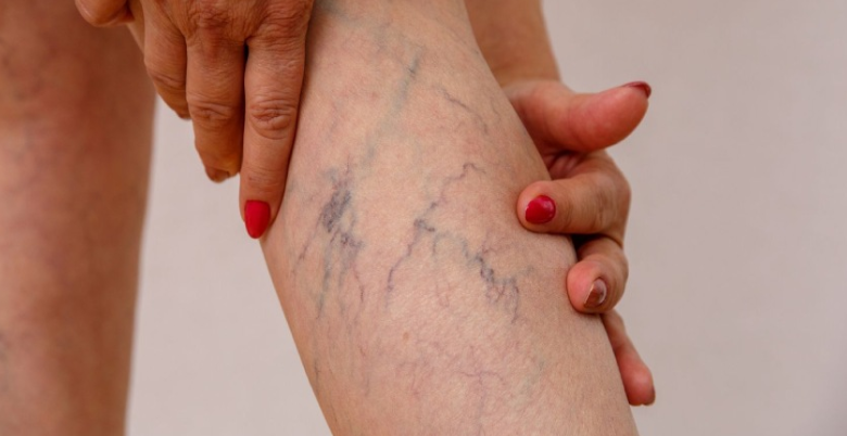 home remedies for ayurvedic treatment of Varicose Veins