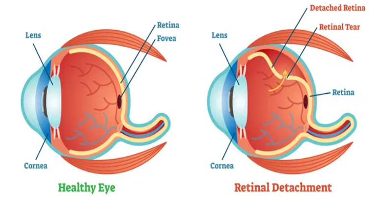 Retinal Detachment ke karan kya hai 