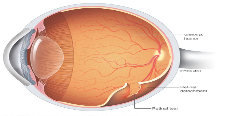 Retinal Detachment ke lakshan kya hai 