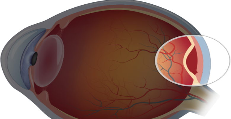 Retinal Detachment ka Ilaz kya hai 