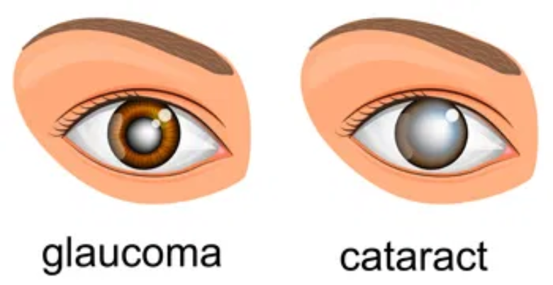 what are the symptoms of glaucoma and cataract 