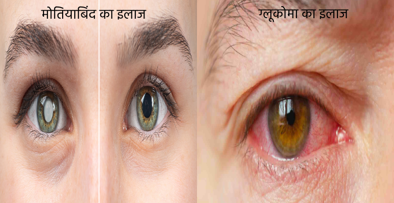 how to treat cataract and glaucoma 