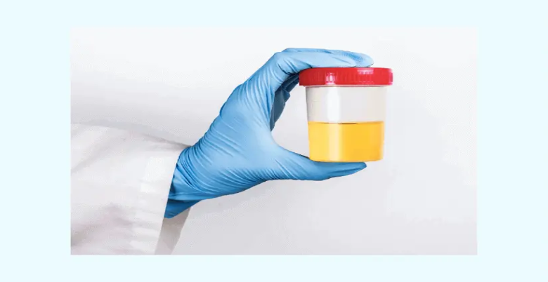 which tests are necessary due to increase in epithelial cells in urine 